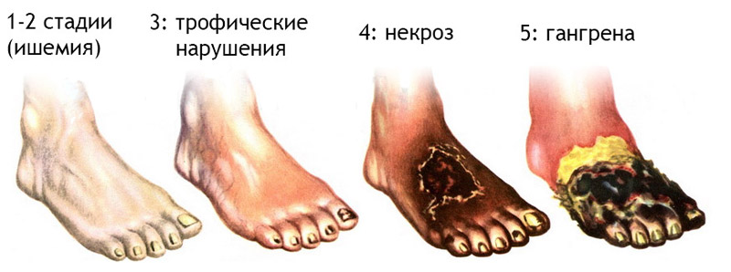 Ампутация пальца ноги при сахарном диабете - причины и последств..