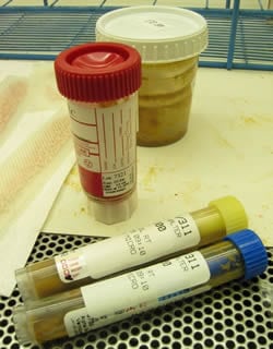 Анализы при панкреатите: какие должны быть показатели в биохимии крови