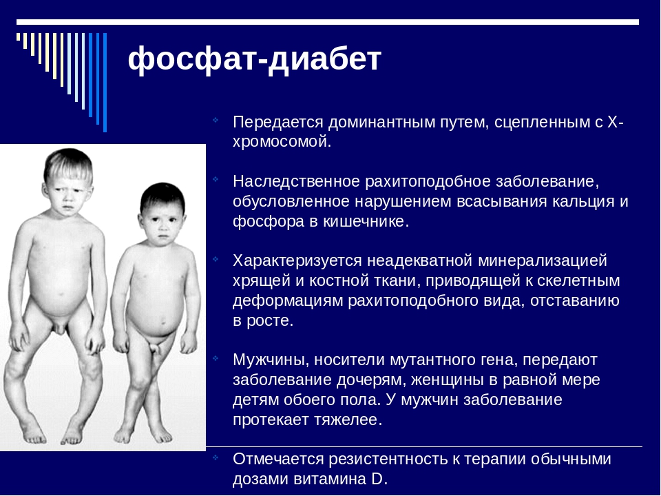 Фосфат-диабет (ФД) у детей