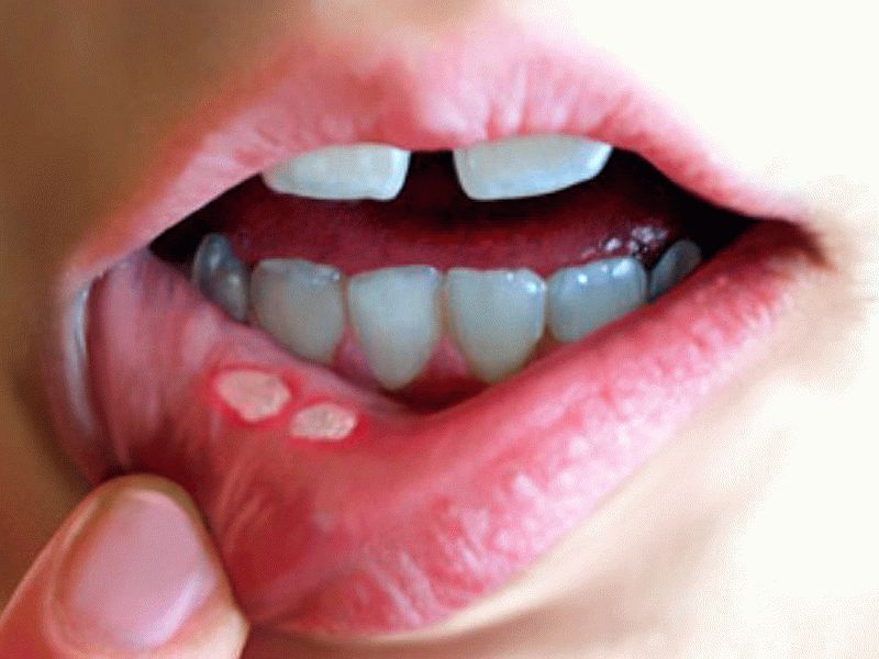 Проявления сахарного диабета в полости рта