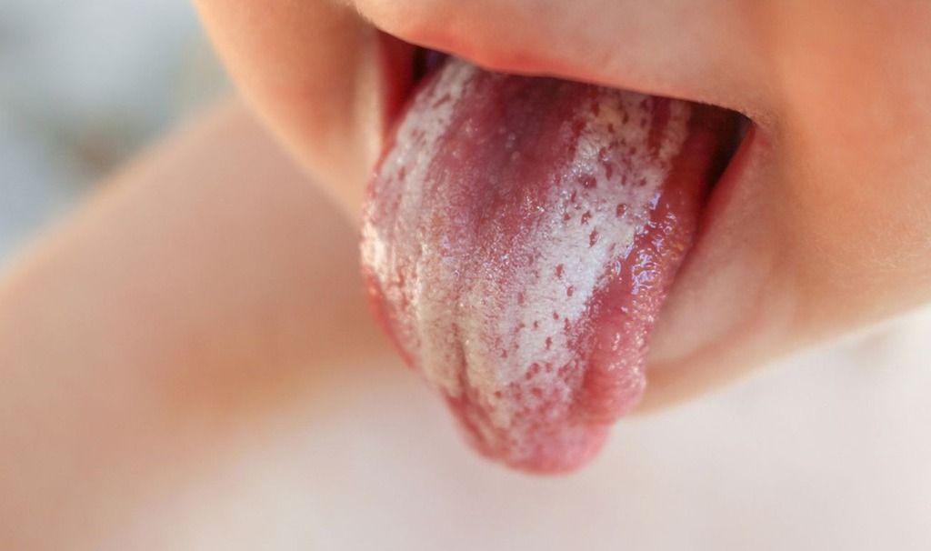 Проявления сахарного диабета в полости рта